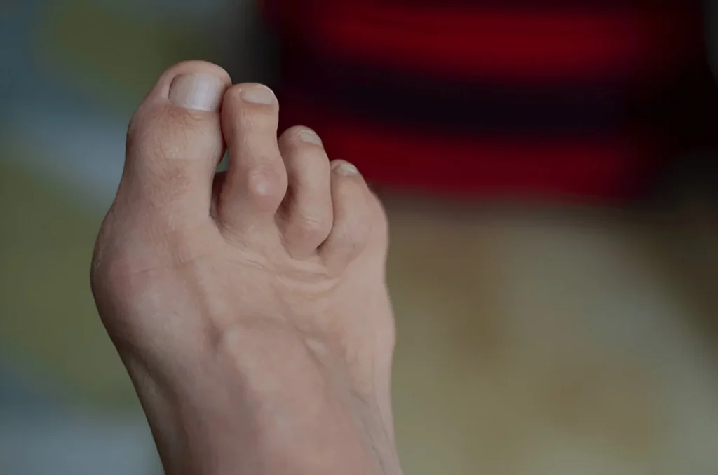 Hammer Toe