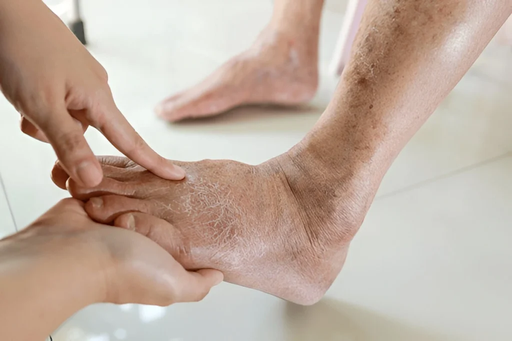 Diabetic Foot Care