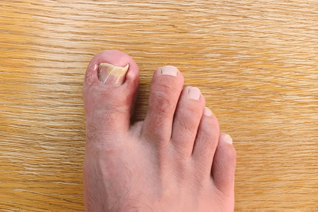 ingrown Toe nail