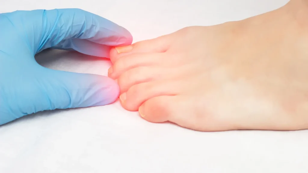 ingrown toenail