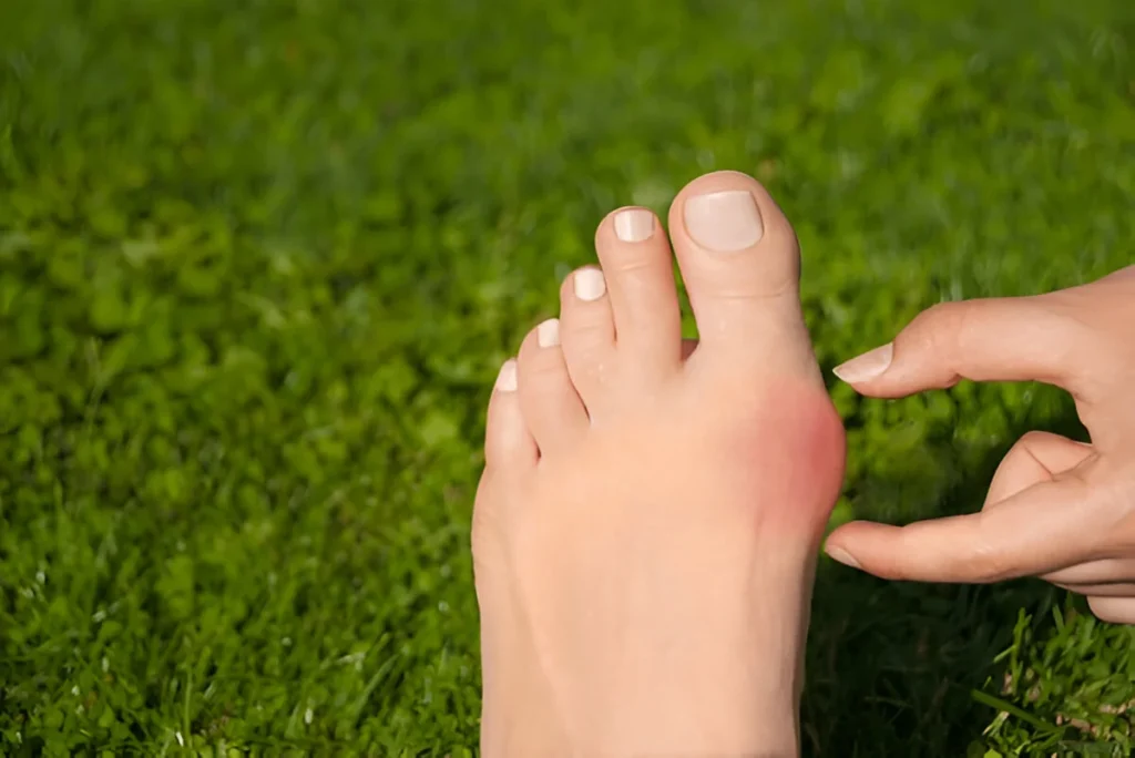 Bunion Pain