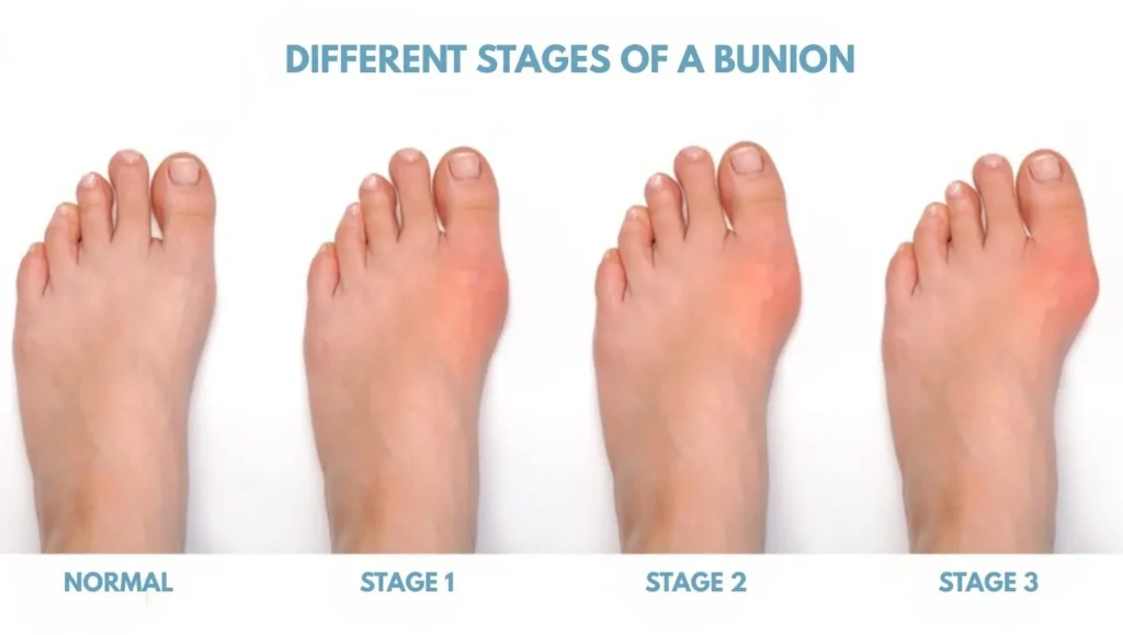 Feel free to ask about bunions from our specialist, contact us today