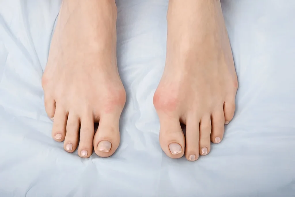 Why Bunion & Foot Pain Are More Common in Women