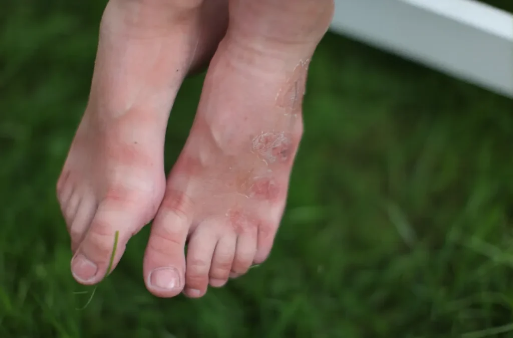 Fungal infection in feet