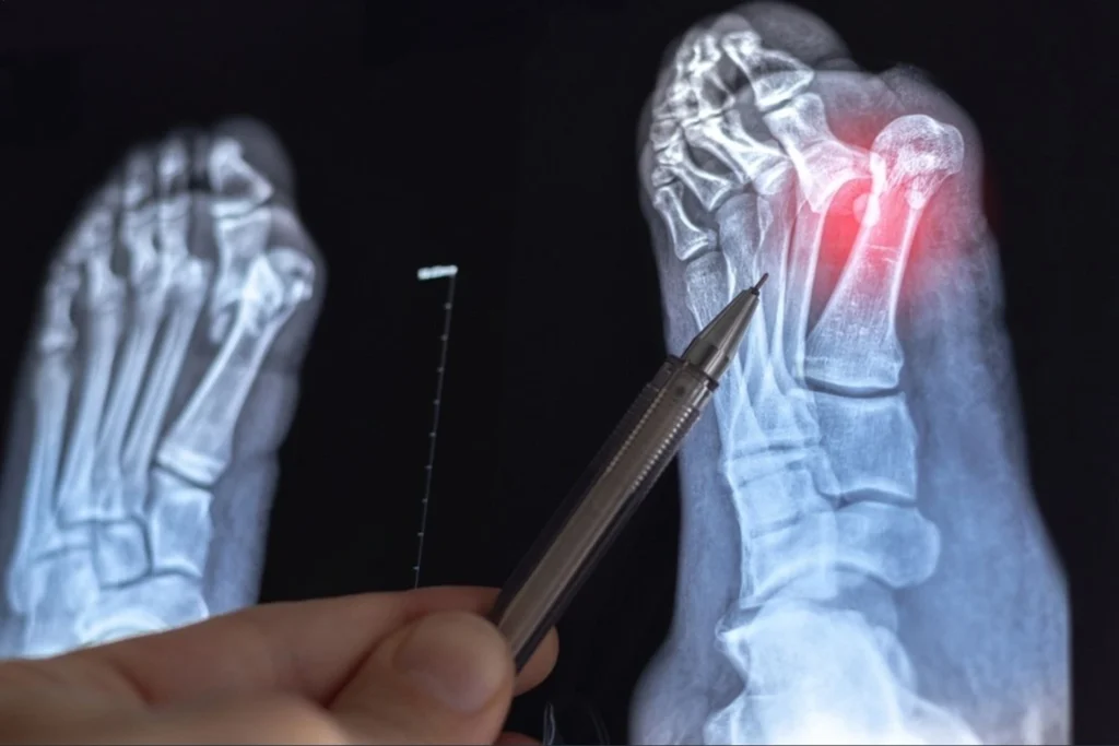 Bunionectomy recovery