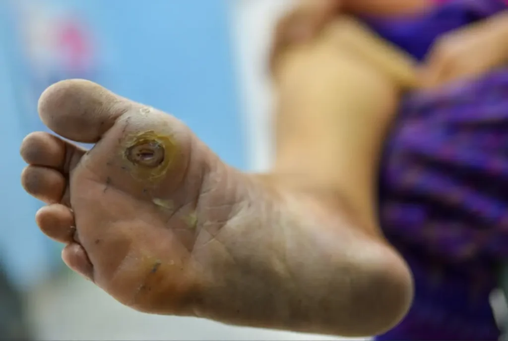 diabetic foot ulcer causes